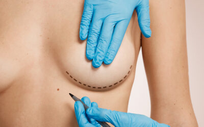  Breast Reduction Surgery: Enhancing Comfort and Confidence
