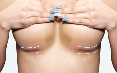 Boosting Confidence with a Breast lift Surgery: A Transformative Journey