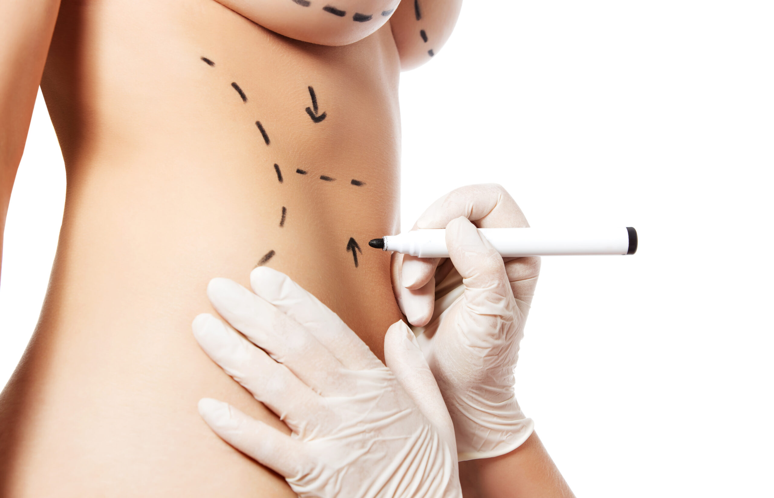 Abdominoplasty<br />
 plastic surgeon london breast surgery liposuction