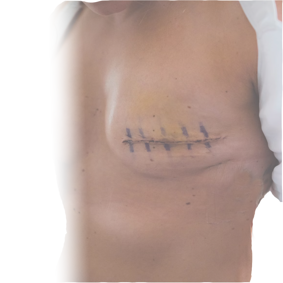 breast reconstruction london breast reconstruction london
