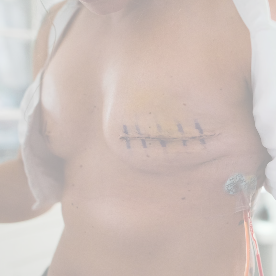 The Transformative Journey of Reconstructive Breast Surgery breast reconstruction surgery treatment