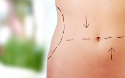 The Incredible Benefits of Fat Transfer Surgery
